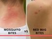 How to Differentiate Between Bed Bug and Mosquito Bites